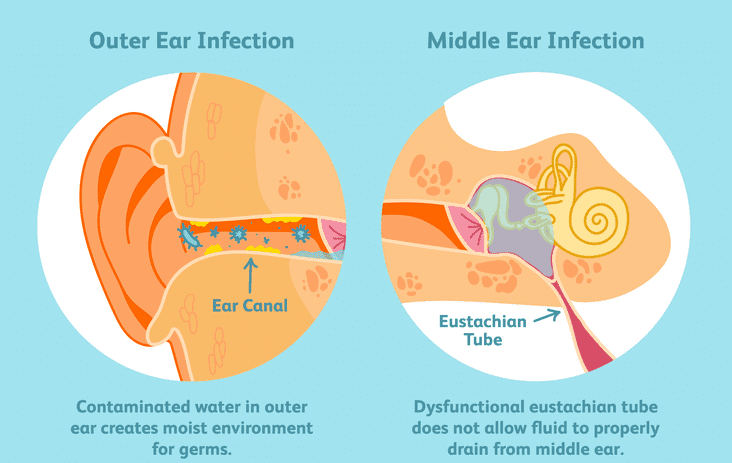 Acute ear infection