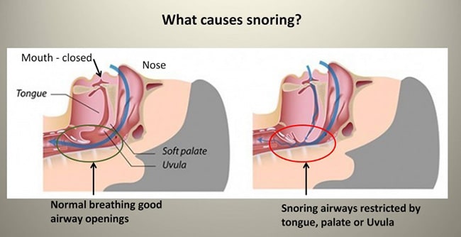 Causes of Snoring