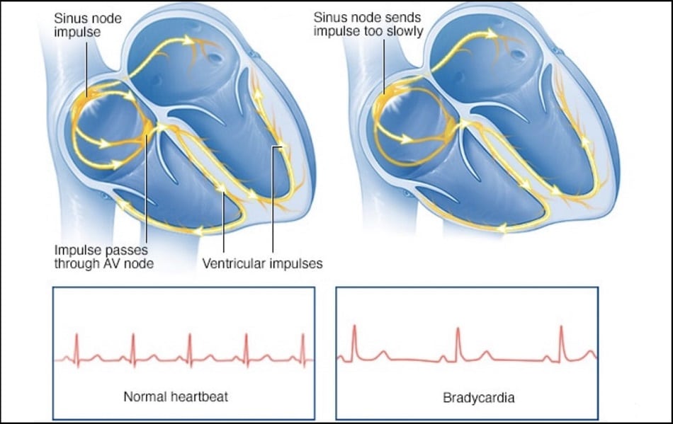 Low Heart Rate Bradycardia