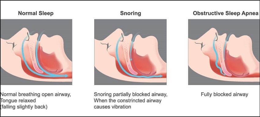 Snoring and apnea