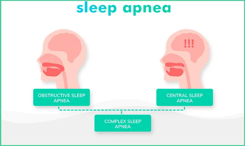 Main Types Sleep Apnea Explained：Obstructive Central