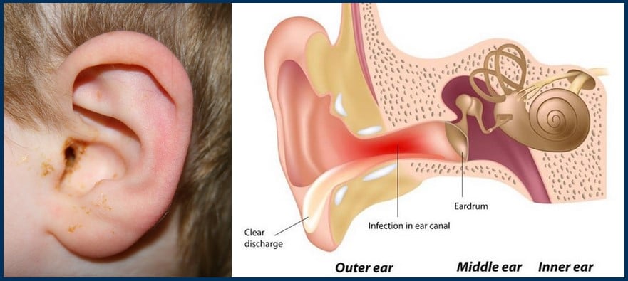 middle and Acute ear infections